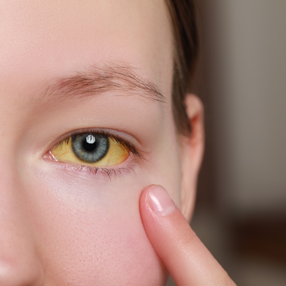 Woman with yellow eyes on blurred background, closeup. Symptom of hepatitis